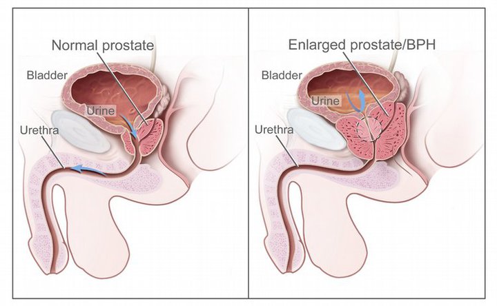 prostatitis poros